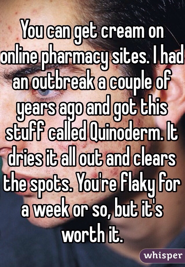 You can get cream on online pharmacy sites. I had an outbreak a couple of years ago and got this stuff called Quinoderm. It dries it all out and clears the spots. You're flaky for a week or so, but it's worth it.