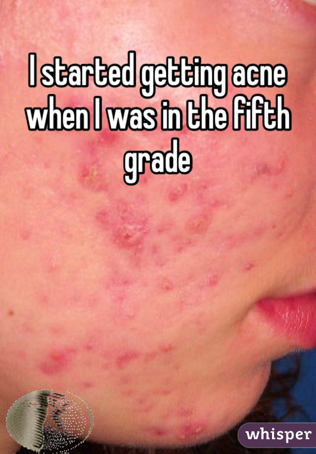 I started getting acne when I was in the fifth grade