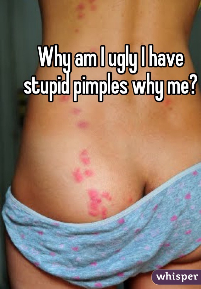 Why am I ugly I have stupid pimples why me?