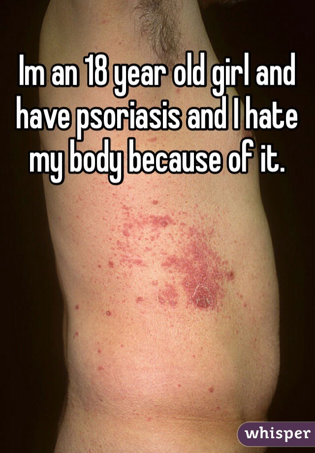 Im an 18 year old girl and have psoriasis and I hate my body because of it. 