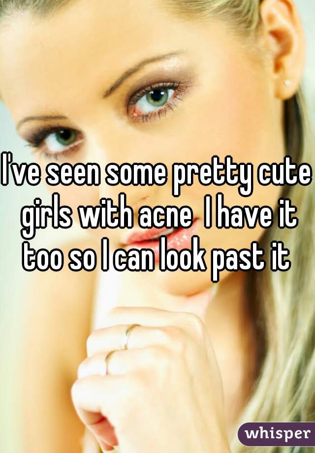 I've seen some pretty cute girls with acne  I have it too so I can look past it 