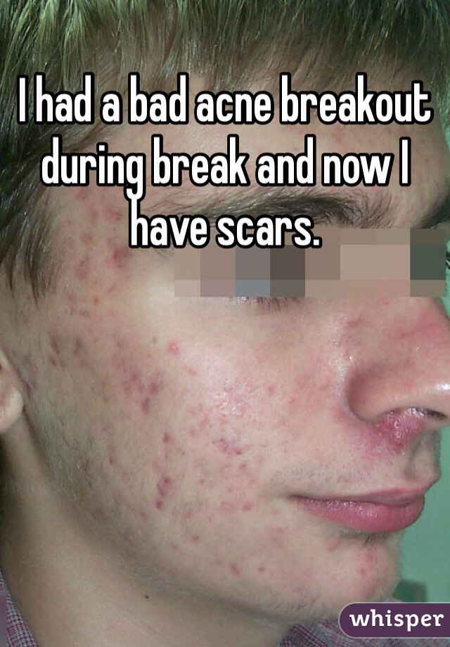 I had a bad acne breakout during break and now I have scars.