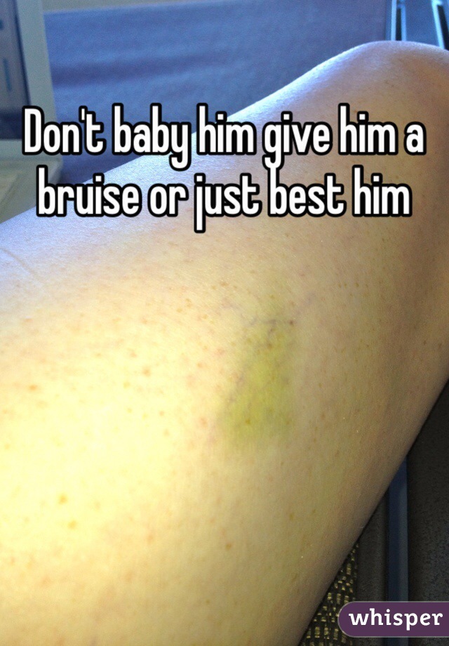 Don't baby him give him a bruise or just best him 