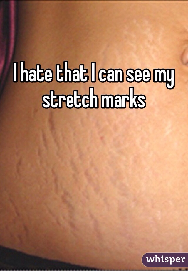 I hate that I can see my stretch marks 