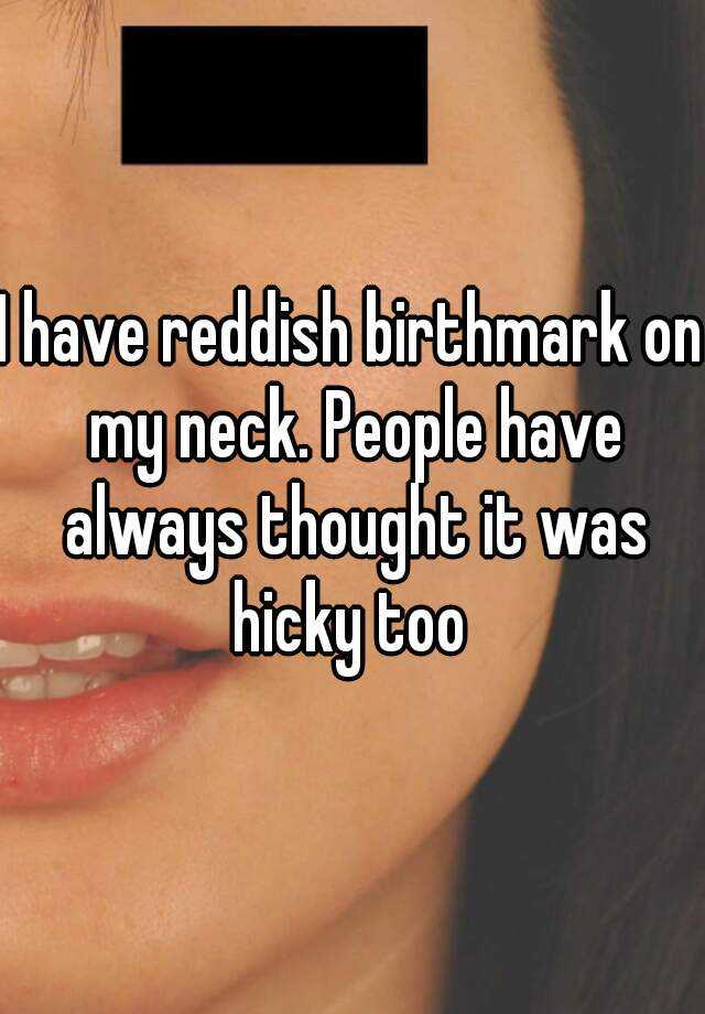 i-have-reddish-birthmark-on-my-neck-people-have-always-thought-it-was