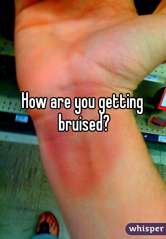 How are you getting bruised?