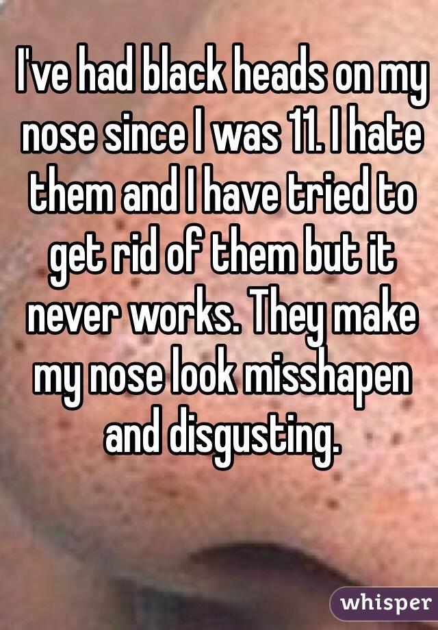 I've had black heads on my nose since I was 11. I hate them and I have tried to get rid of them but it never works. They make my nose look misshapen and disgusting. 