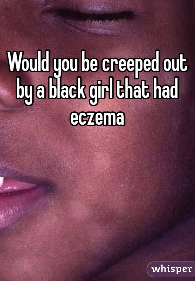Would you be creeped out by a black girl that had eczema 