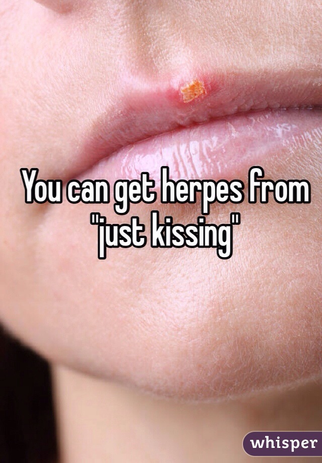 You can get herpes from "just kissing"