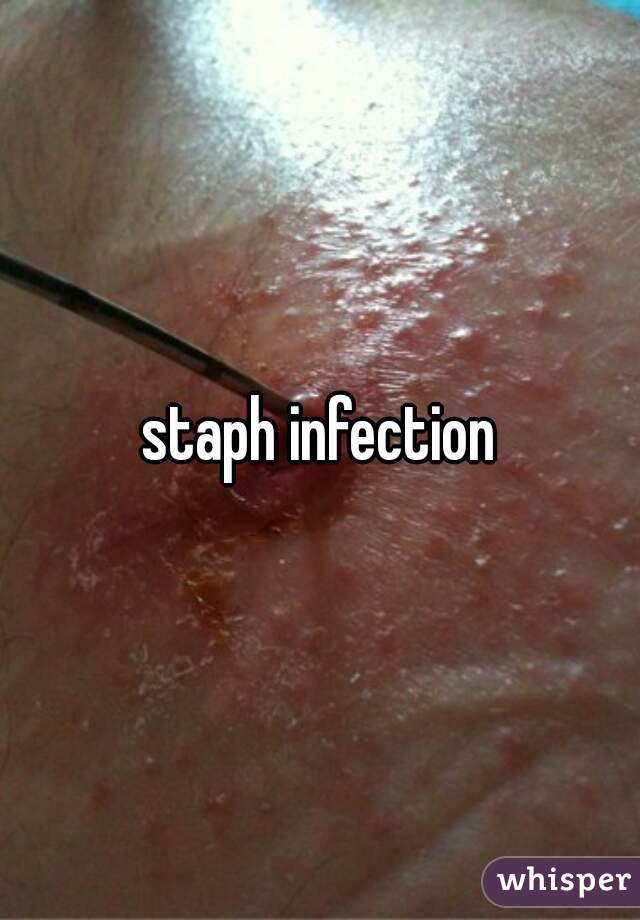 staph infection