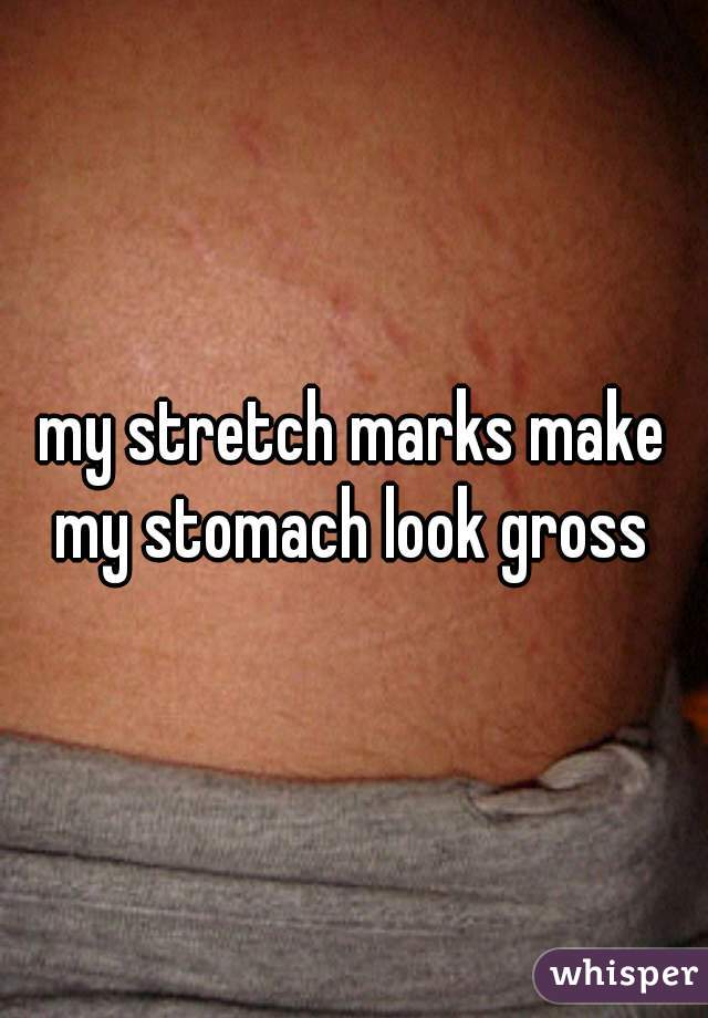 my stretch marks make my stomach look gross 