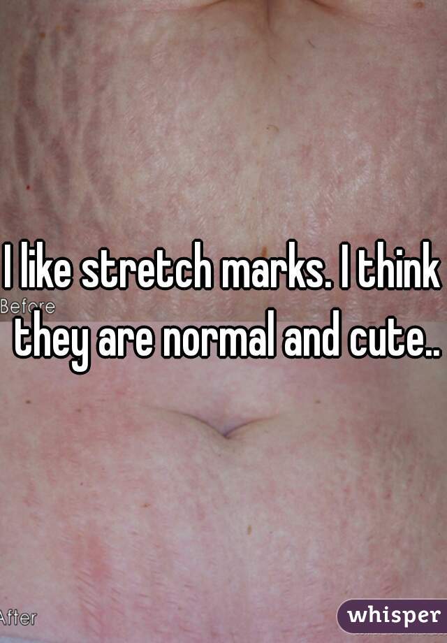 I like stretch marks. I think they are normal and cute..