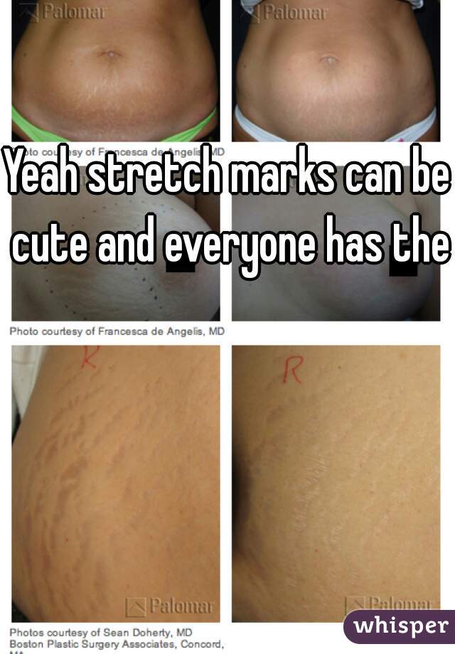 Yeah stretch marks can be cute and everyone has them
