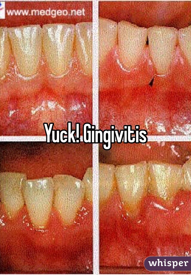 Yuck! Gingivitis 