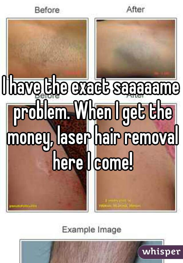 I have the exact saaaaame problem. When I get the money, laser hair removal here I come!