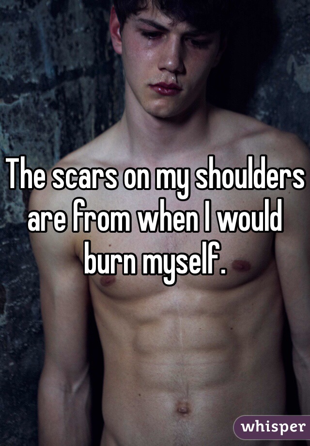 The scars on my shoulders are from when I would burn myself.