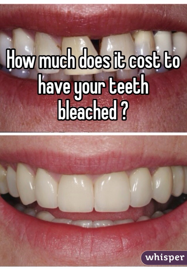 How much does it cost to have your teeth bleached ? 