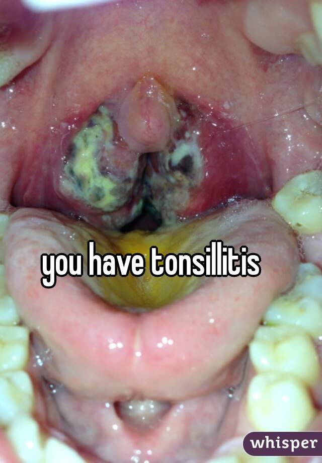you have tonsillitis