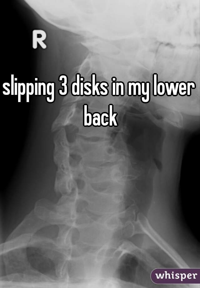 slipping 3 disks in my lower back