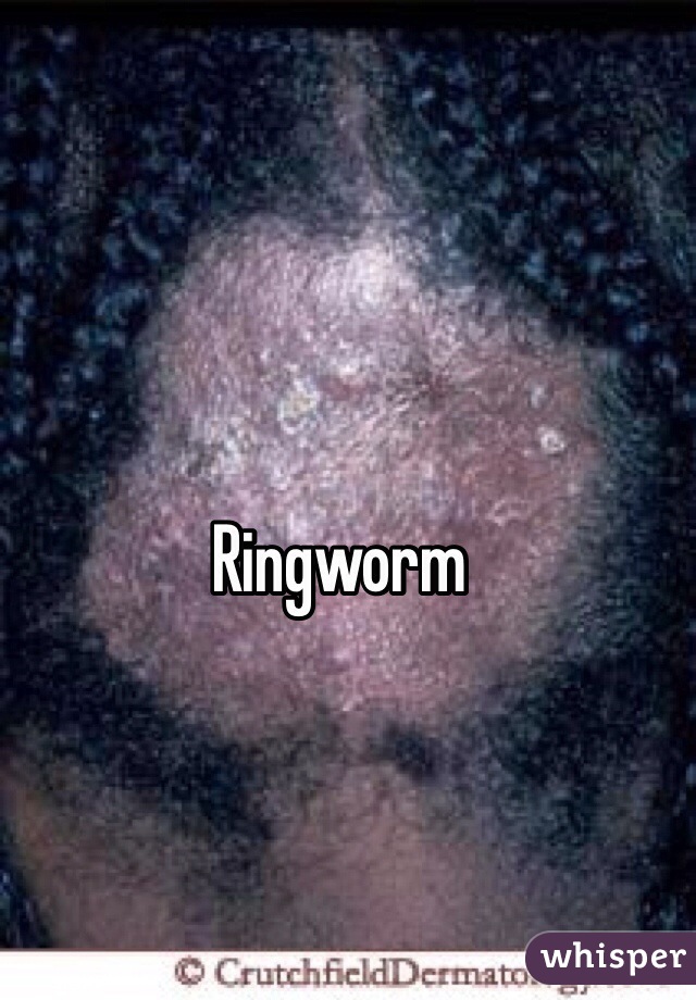 Ringworm 