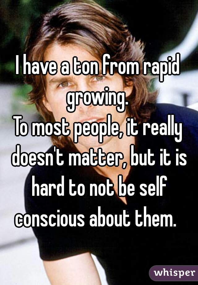 I have a ton from rapid growing. 
To most people, it really doesn't matter, but it is hard to not be self conscious about them.  