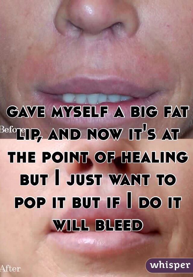 gave myself a big fat lip, and now it's at the point of healing but I just want to pop it but if I do it will bleed