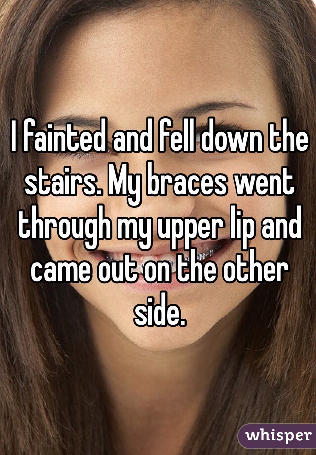 I fainted and fell down the stairs. My braces went through my upper lip and came out on the other side. 