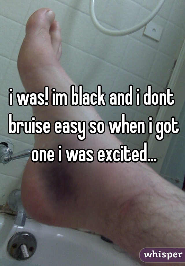 i was! im black and i dont bruise easy so when i got one i was excited...