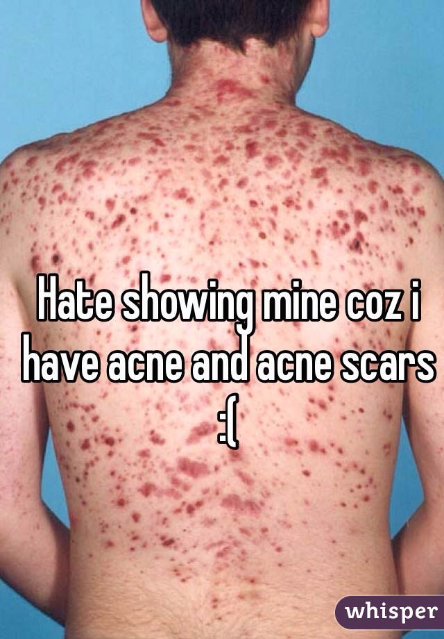 Hate showing mine coz i have acne and acne scars
:(
