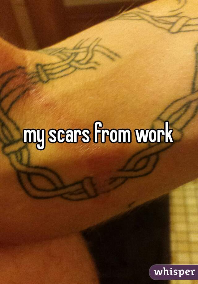 my scars from work