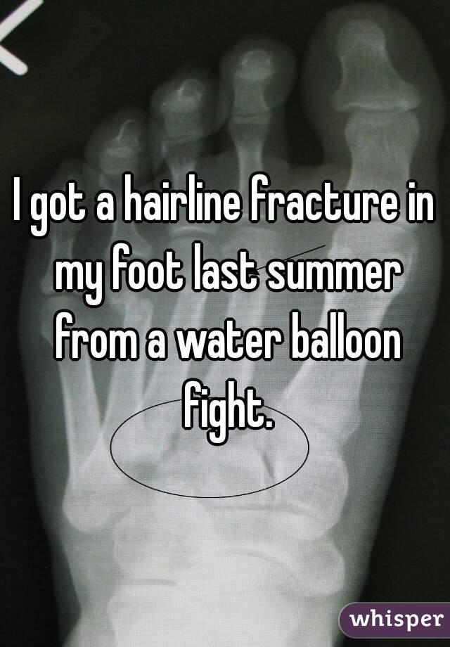 I got a hairline fracture in my foot last summer from a water balloon fight.