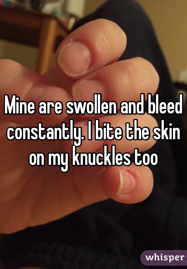 Mine are swollen and bleed constantly. I bite the skin on my knuckles too 