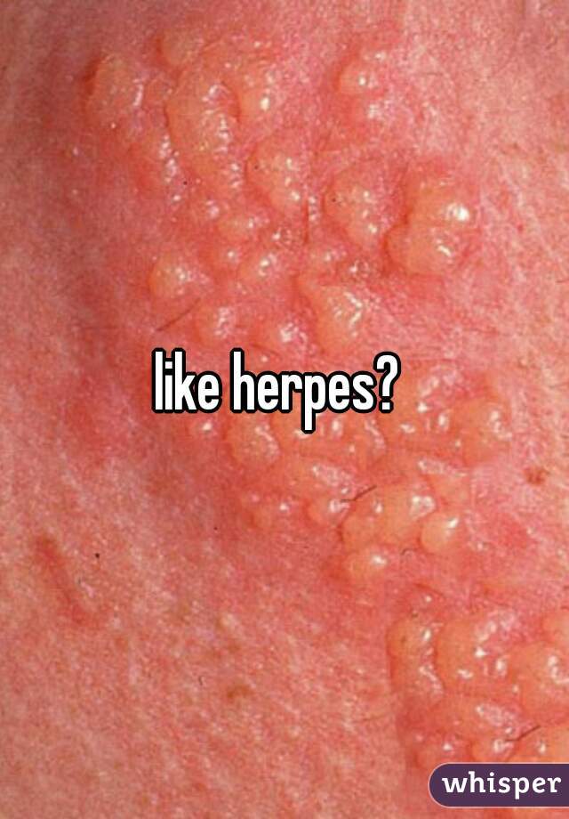 like herpes? 
