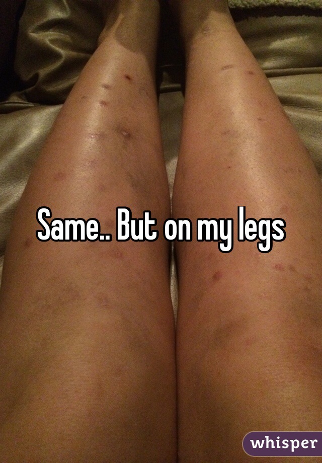 Same.. But on my legs
