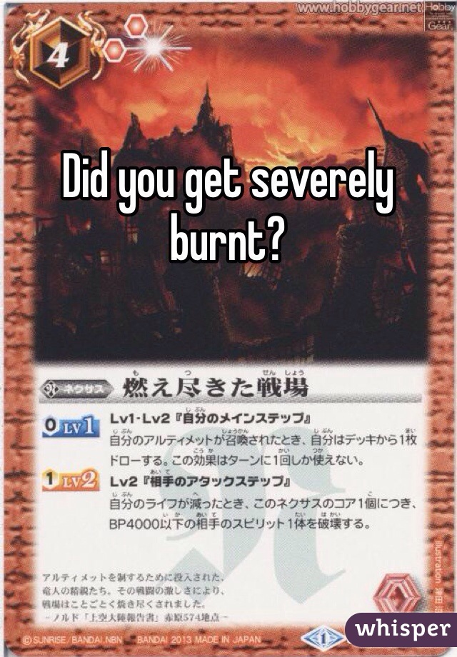 Did you get severely burnt? 