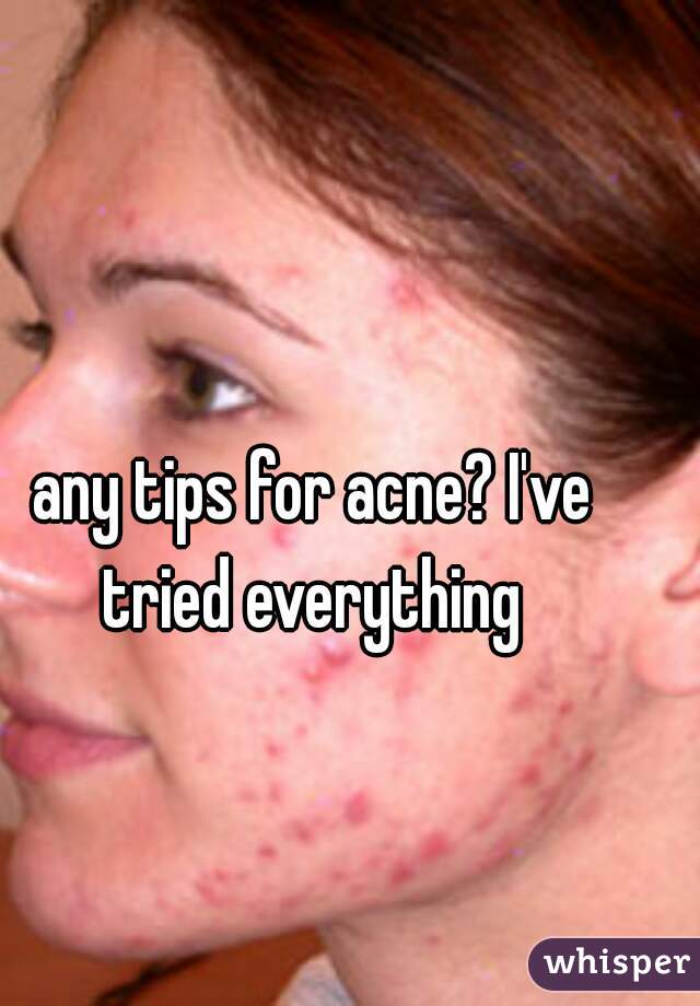 any tips for acne? I've tried everything 