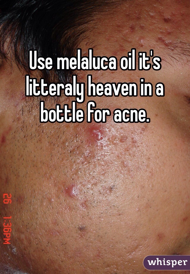 Use melaluca oil it's litteraly heaven in a bottle for acne. 