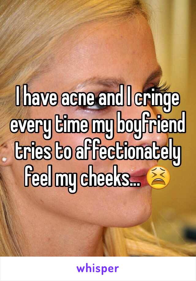 I have acne and I cringe every time my boyfriend tries to affectionately feel my cheeks... 😫