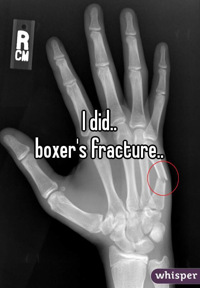 I did..
boxer's fracture..