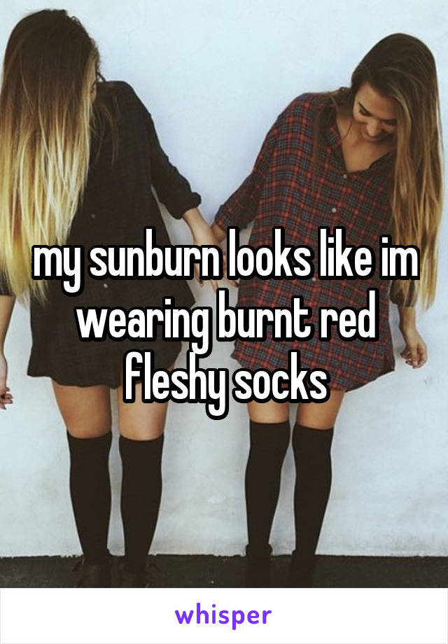 my sunburn looks like im wearing burnt red fleshy socks