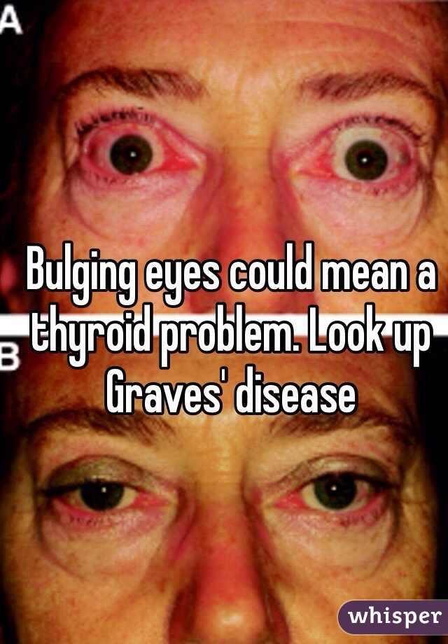 Bulging eyes could mean a thyroid problem. Look up Graves' disease 
