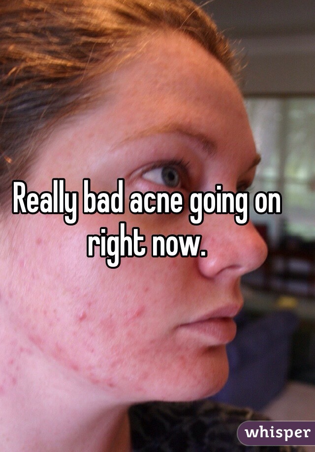Really bad acne going on right now.