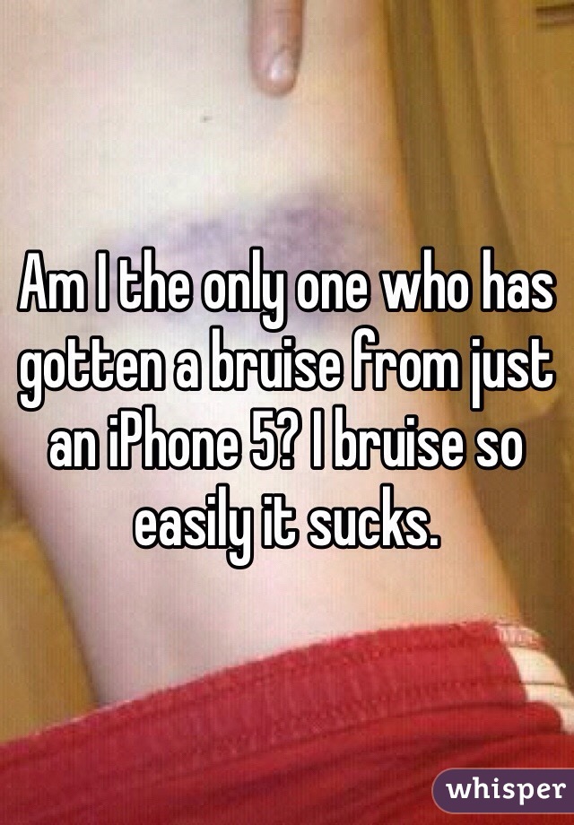 Am I the only one who has gotten a bruise from just an iPhone 5? I bruise so easily it sucks. 