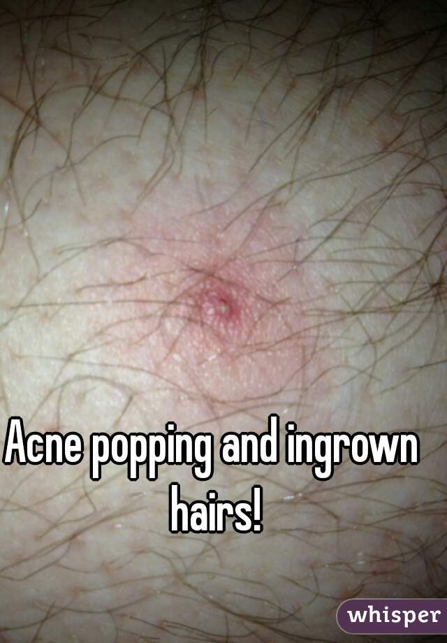 Acne popping and ingrown hairs!