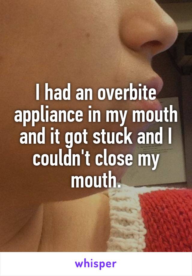 I had an overbite appliance in my mouth and it got stuck and I couldn't close my mouth.