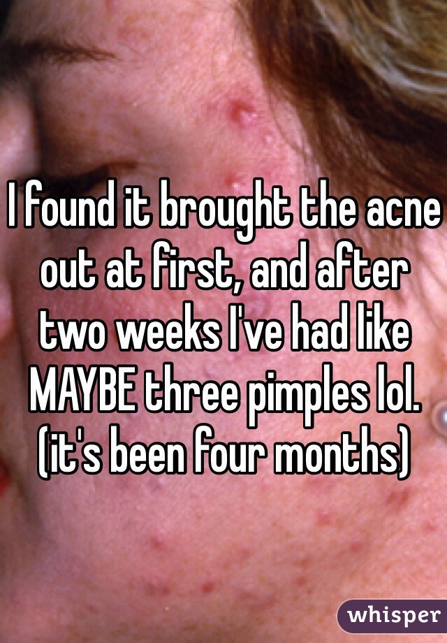 I found it brought the acne out at first, and after two weeks I've had like MAYBE three pimples lol. (it's been four months) 