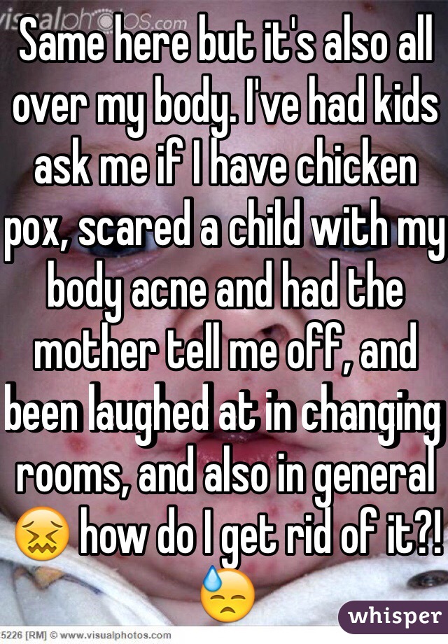 Same here but it's also all over my body. I've had kids ask me if I have chicken pox, scared a child with my body acne and had the mother tell me off, and been laughed at in changing rooms, and also in general 😖 how do I get rid of it?! 😓