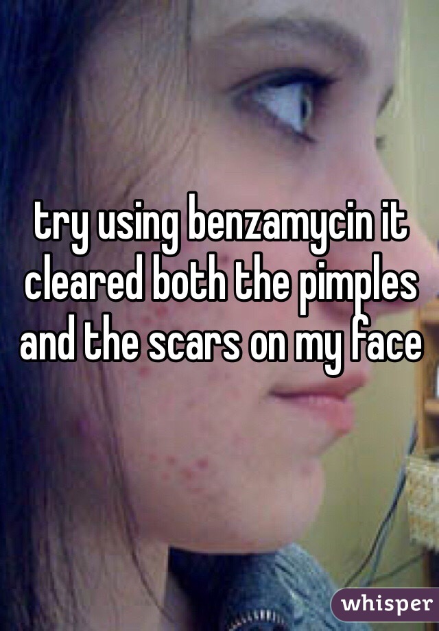 try using benzamycin it cleared both the pimples and the scars on my face