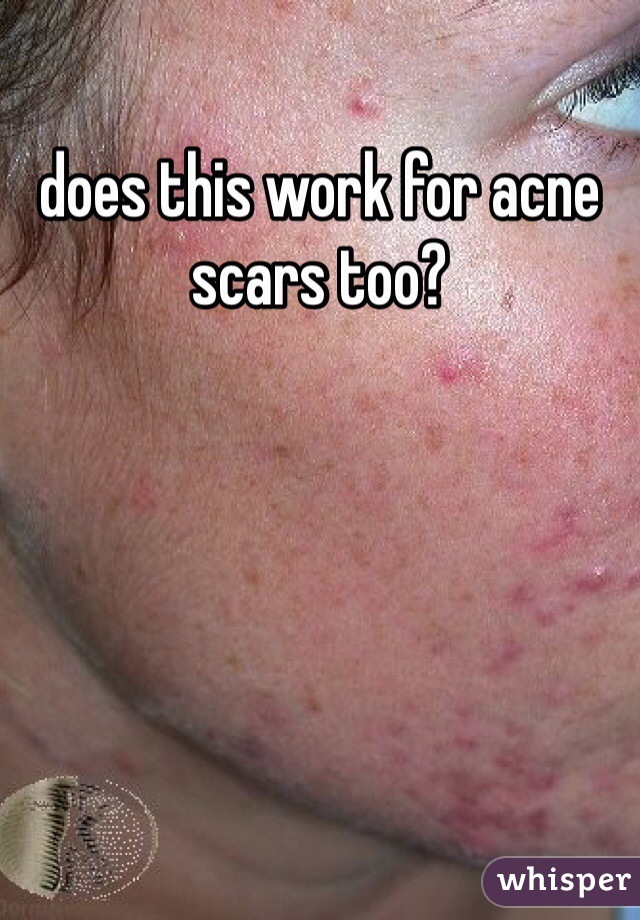 does this work for acne scars too?