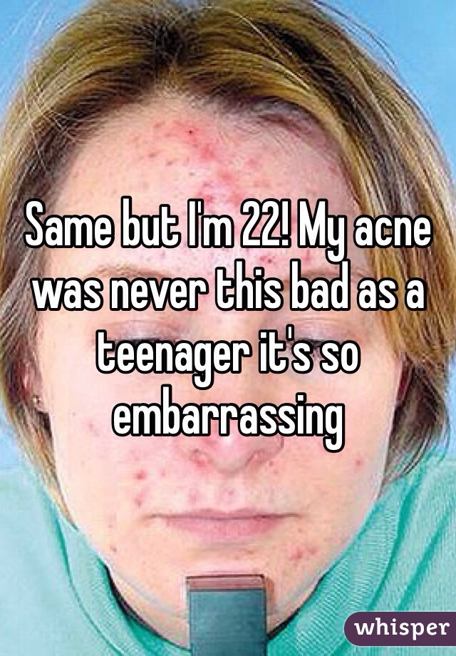 Same but I'm 22! My acne was never this bad as a teenager it's so embarrassing 